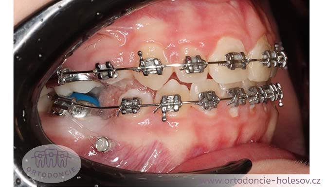 Kotevní miniimplantáty